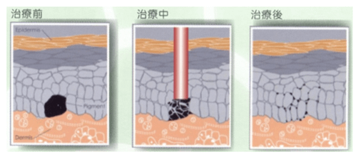 我嘅陳年斑點有救啦！皮秒激光去斑效果原來是咁的……