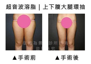 上下腹大腿環抽1.jpg