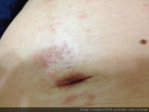 胎毒