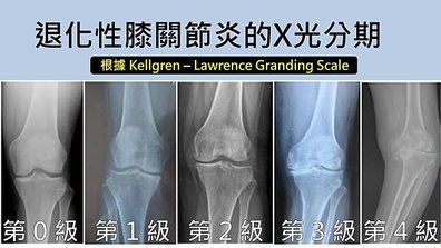 KL scale f knee joint.JPG