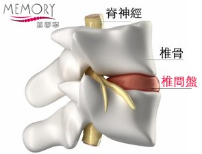 椎間盤拷貝