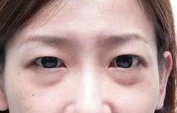 眼袋形成的主要原因