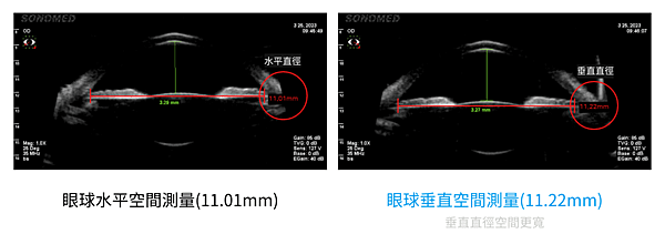 不旋轉‧垂直型散光矯治ICL植入式微型鏡片手術 V-Tori