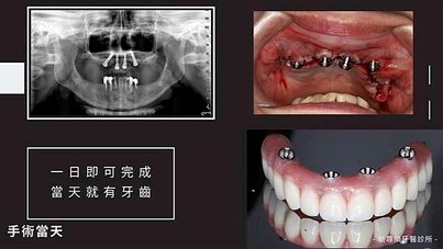 朋友阿凱的啟發｜All on 6一日全口重建心得