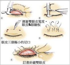 台中縫雙眼皮01