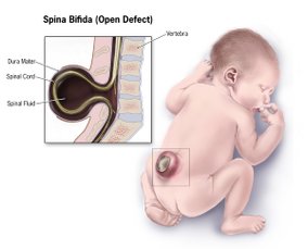 spina_bifida_tcm63-8755