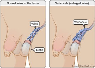 IMD_varicocele_EN_72.jpg