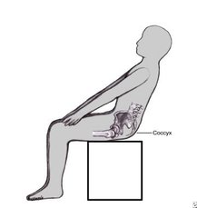 coccdynix worse when sitting backward.jpg