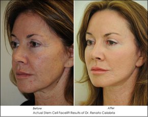 Stem-Cell-Facelift-Calabria-B-A-Pat3.jpg