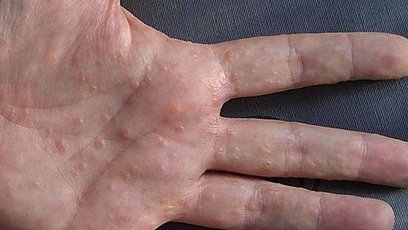 dyshidrotic_eczema_hand_2.JPG