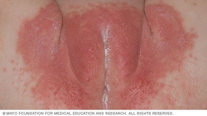 fl00090-diaper-rash.jpg