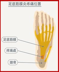 足底筋膜炎位置.jpg