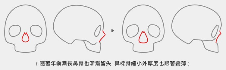 洢蓮絲隆鼻洢蓮絲ellanse聚己內酯PCL依戀詩易麗適少女針微晶瓷晶亮瓷隆鼻06.jpg