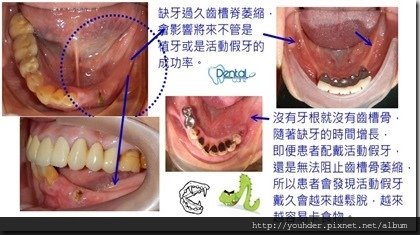 齒槽脊萎縮