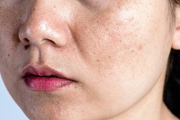 woman-with-problematic-skin-acne-scars-wrinkles-dark-spots_53476-4001.jpg