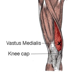 blog-vastus-med.jpg