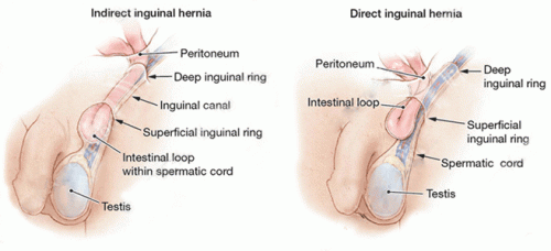 Inguinal-hernia-surgery-in-Bangalore.gif