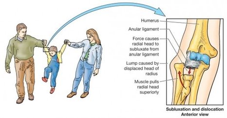 radial_head_subluxation1311223336154-520x270.jpg