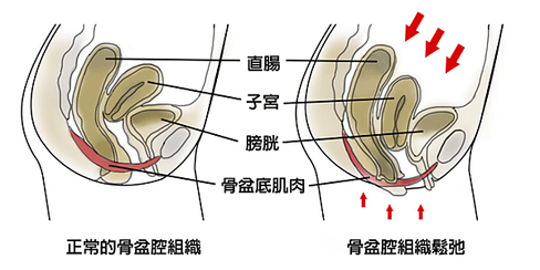 應力性尿失禁.png