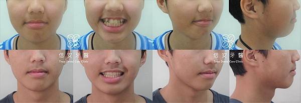 invisalign-1.jpg