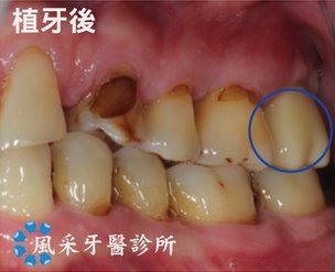 楊先生植牙後