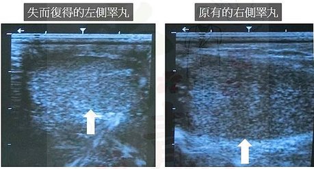 雙側睪丸超音波.jpg