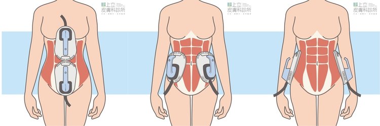 EMSCULPT肌動減脂肌動翹臀林上立增肌減脂推薦上立皮膚科診所