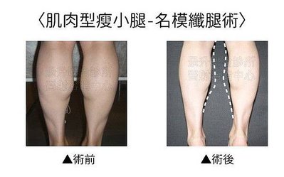 calf-slimming-1.jpg