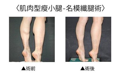 calf-slimming-2.jpg