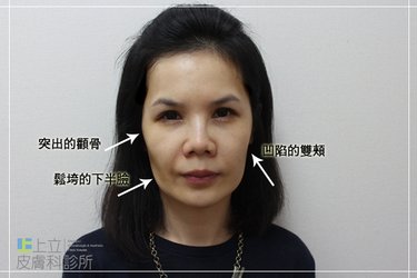 老人胖老人瘦少女計劃林上立醫生液態拉皮上立提 液態拉皮 推薦 3D聚左旋乳酸 舒顏萃 童顏針 3D聚左旋乳酸 價格 3D聚左旋乳酸 費用 Ellansé 洢蓮絲少女針PolycaprolactonePCL膠原增生劑易麗適依戀詩02.jpg