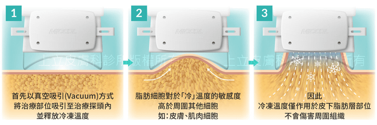 MICOOL-S冷凍溶脂效果冷凍溶脂價錢冷凍減脂心得冷凍溶脂推薦冷凍溶脂ptt冷凍溶脂原理冷凍溶脂術後瘦肚子的方法快速瘦肚子運動瘦肚子按摩快速瘦小腹運動瘦肚子飲食瘦肚子05.png