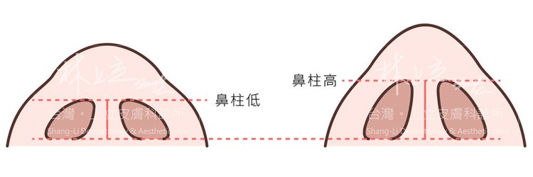 微晶瓷晶亮瓷洢蓮絲隆鼻洢蓮絲ellanse聚己內酯PCL依戀詩易麗適少女針奇蹟針洢蓮絲費用價格隆鼻上立醫師上立皮膚科診所09.jpg