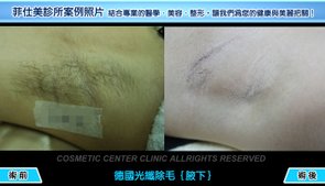1a腋下除毛術前-術後.jpg