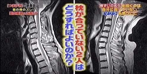 全民家庭醫學--頸椎位移健康大危機