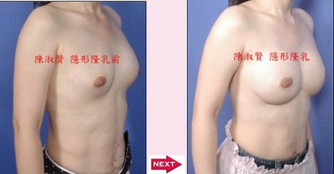 二次隆乳手術案例01