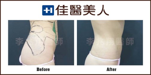 李兆翔医师 – 威塑体雕展自信！男女诉求大不同11.jpg