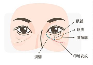 眼袋_淚溝印地安紋眼袋瞼頰溝臥蠶-768x538