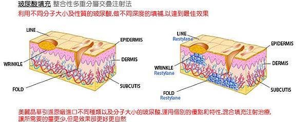 光纖粉餅雷射蘋果肌玻尿酸3D聚左旋乳酸電波拉皮微晶瓷瓜子臉CPT電波拉皮維納斯曲線電波4D羽毛線拉提12.jpg