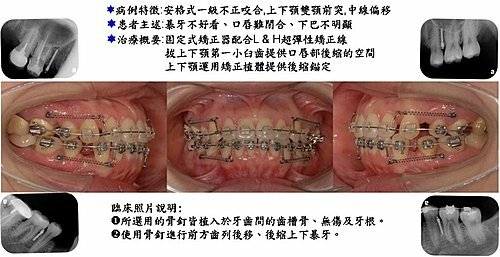 @齒顎矯正每日一說~~0226齒間骨釘(interdenta