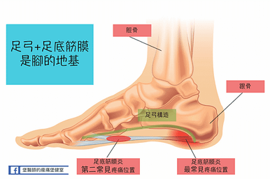 足底筋膜炎-2.png