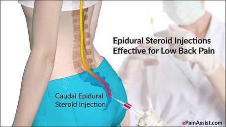 Epidural-Steroid-Injections-Effective-for-Low-Back-Pain.jpg