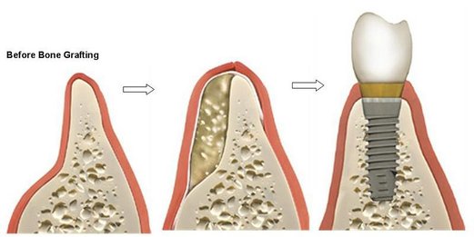 Bone-Grafting