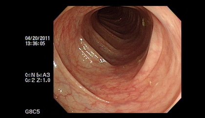 大腸鏡不可怕