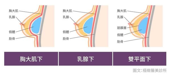 果凍矽膠隆乳後遺症果凍矽膠隆乳心得果凍矽膠隆乳費用果凍隆乳ptt隆乳後遺症果.jpg