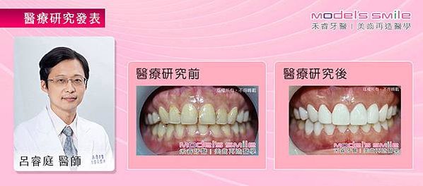 【台北牙醫 星鑽超薄瓷牙貼片 全瓷牙冠 牙齦整形實例】 舞者重塑必勝微笑曲線 全面找回自信