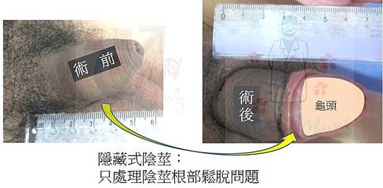 異體真皮增大的龜殼效應困擾-上篇(The turtle-sh