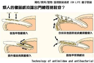 黴菌感染