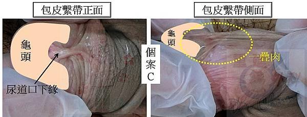 包皮環切前後的繫帶變化--個案探討(上) (The case