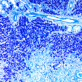 TQF Dog Mast Cell Tumor 100x.png