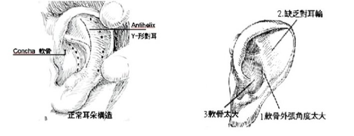 招風耳示意